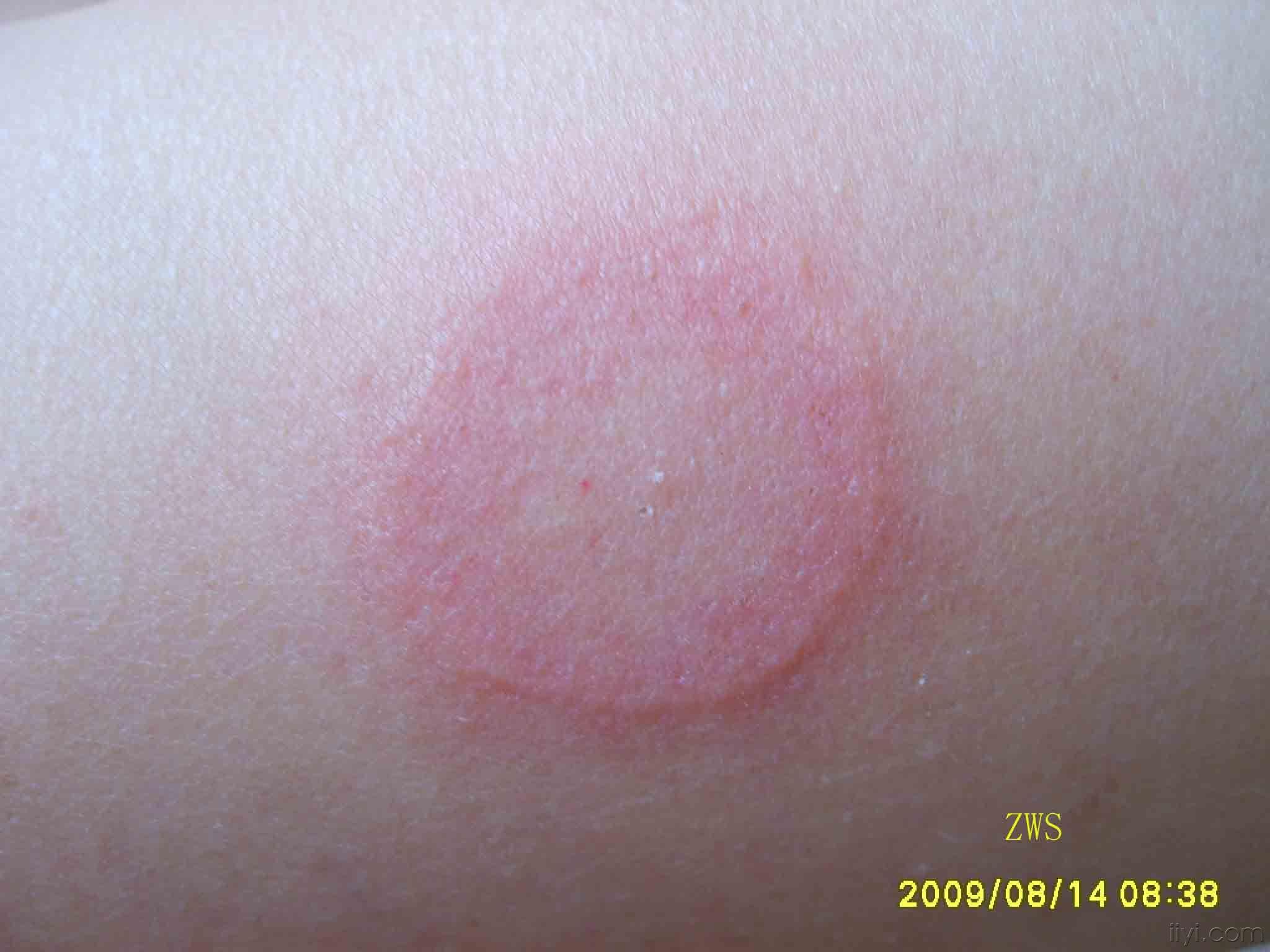 梅毒环形红斑图片图片