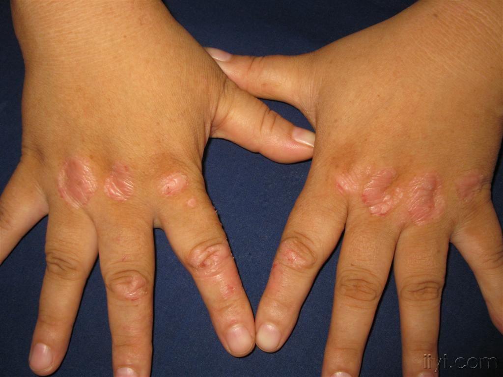 看图识病指节神经性皮炎