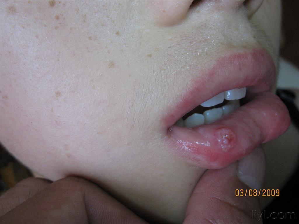 川崎病嘴唇照片图片