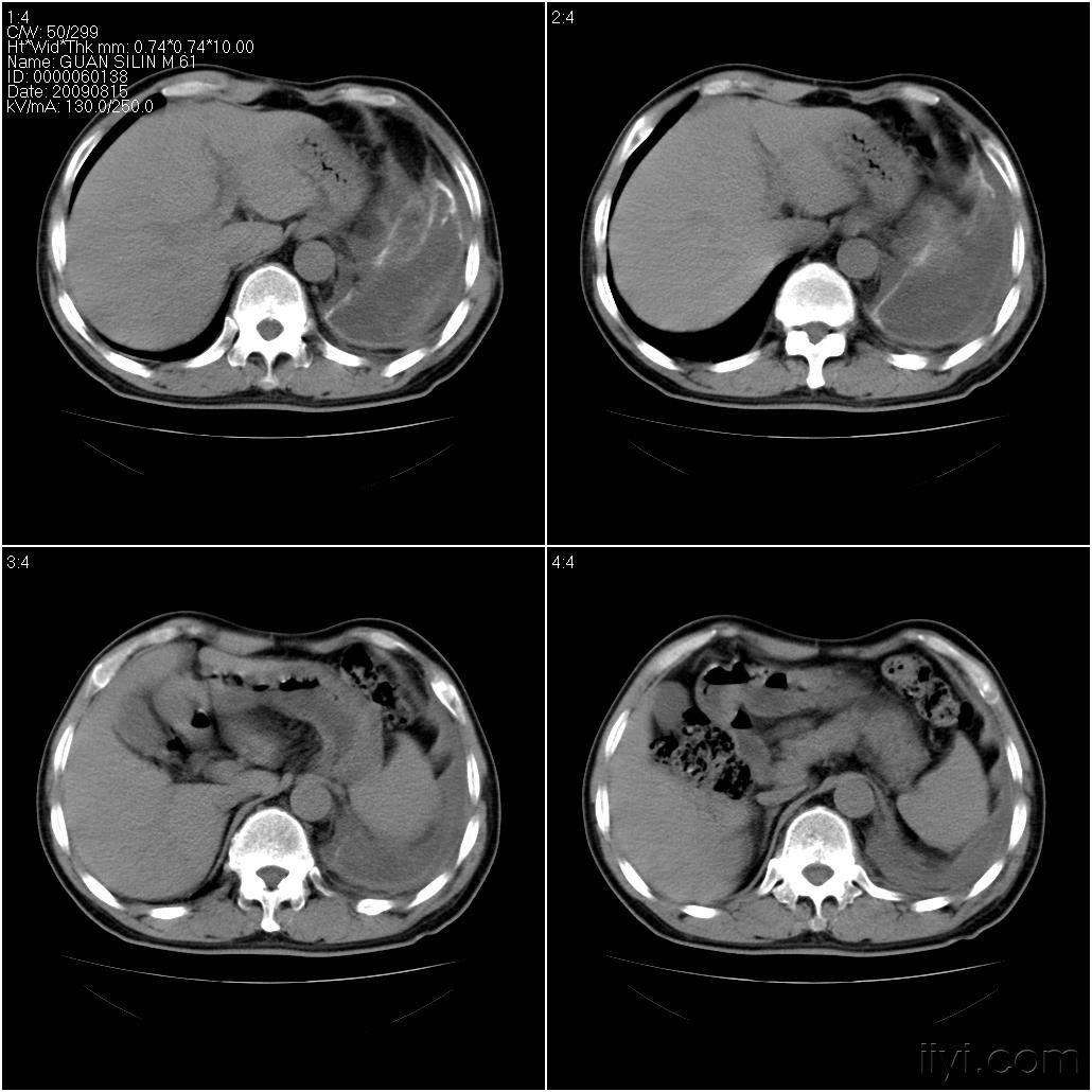 男性61岁左肺癌胸水形成3个月前接受左侧胸腔镜下胸膜固定术