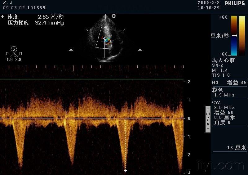 典型肥厚型梗阻性心肌病 - 超声医学讨论版 - 爱爱医医学论坛
