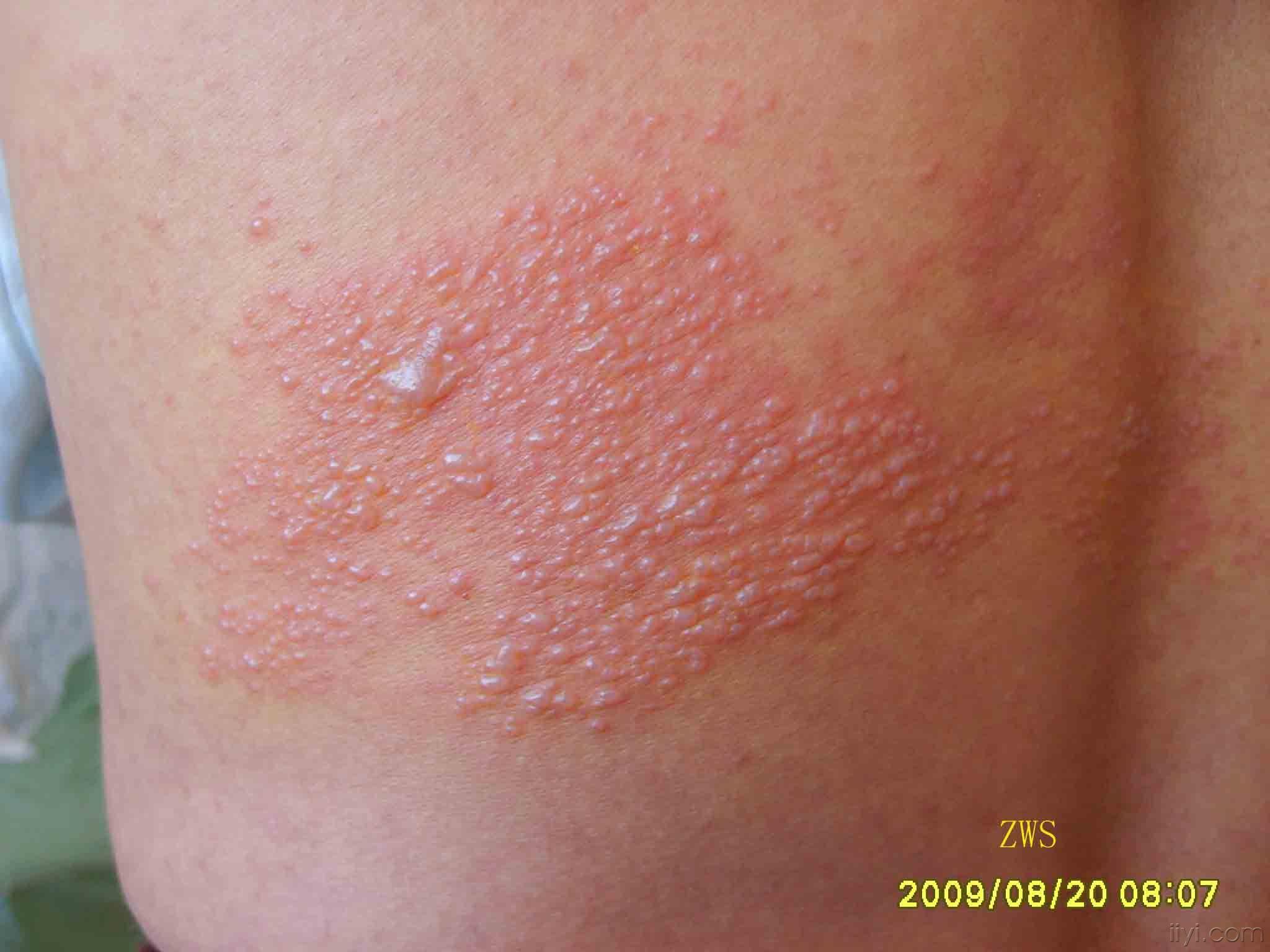 典型病例带状疱疹