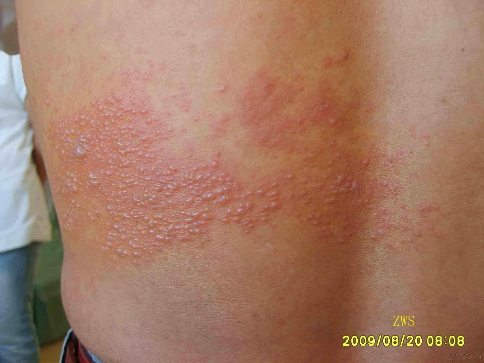带状性疱疹初期图片图片