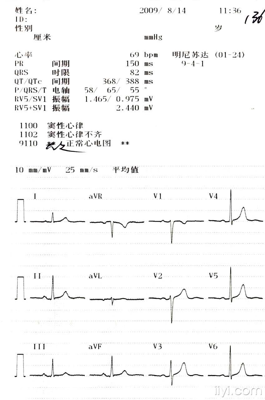 再麻烦看一下我朋友28岁的心电图窦性心律不齐怎么治疗后果有多严重