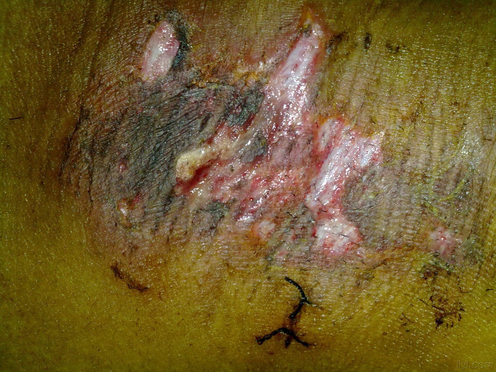 狐臭手术疤痕图 微创图片
