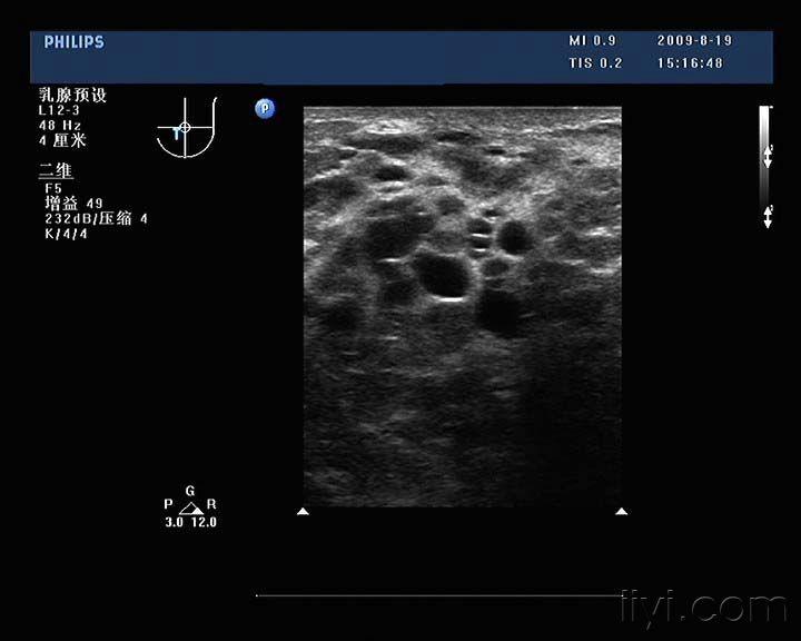 哺乳期乳汁淤积