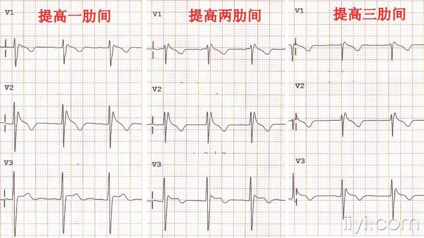 brugada综合症? - 心电图脑电图专业讨论版 - 爱爱医医学论坛
