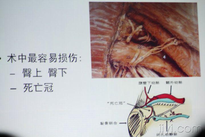 死亡冠血管位置图片