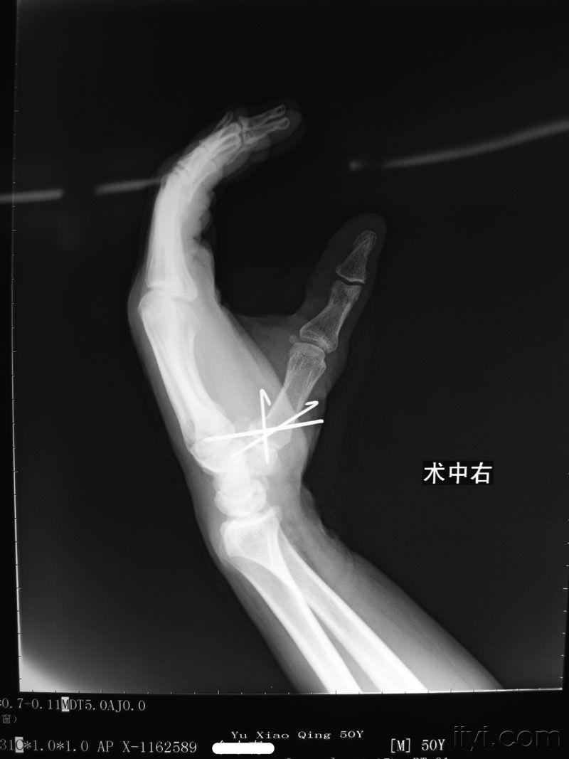 病例讨论第一掌骨基底部骨折闭复内固定一例