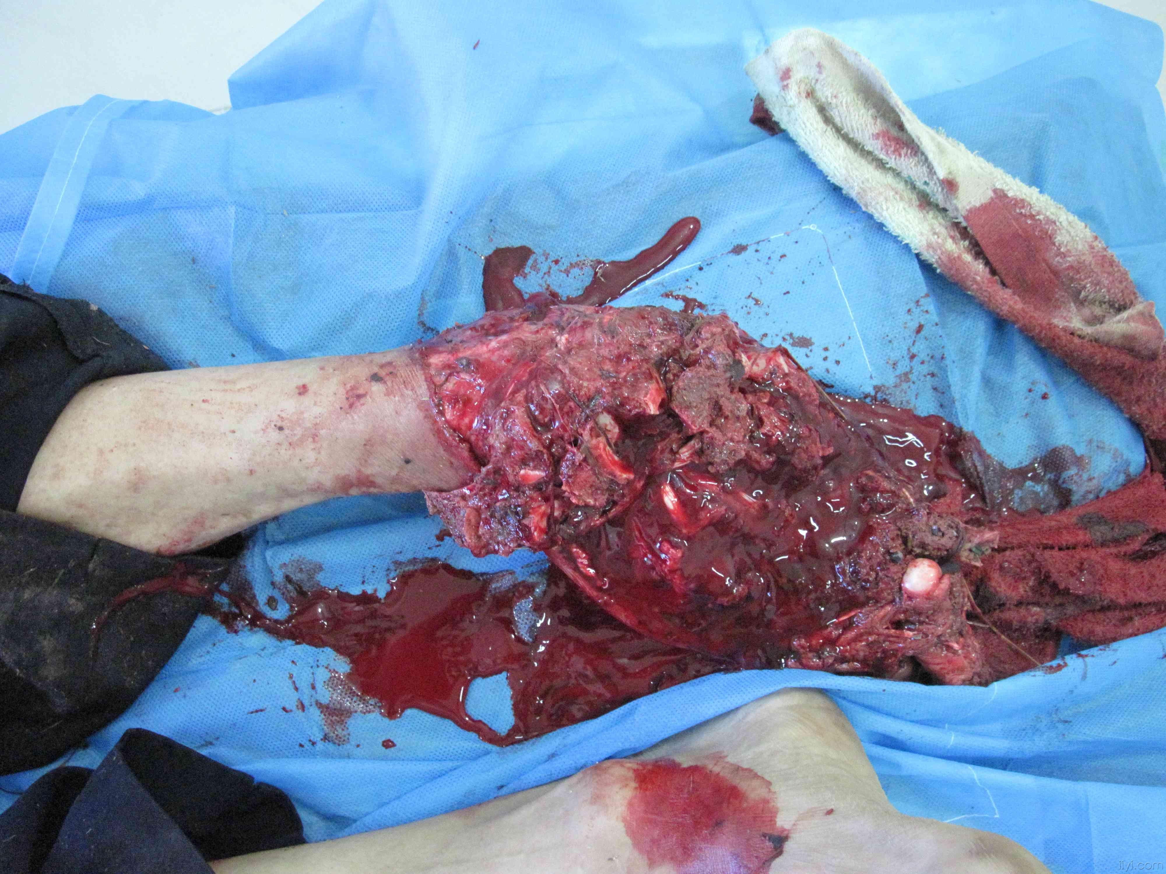 读片会左足毁损伤大家帮忙看看怎么治