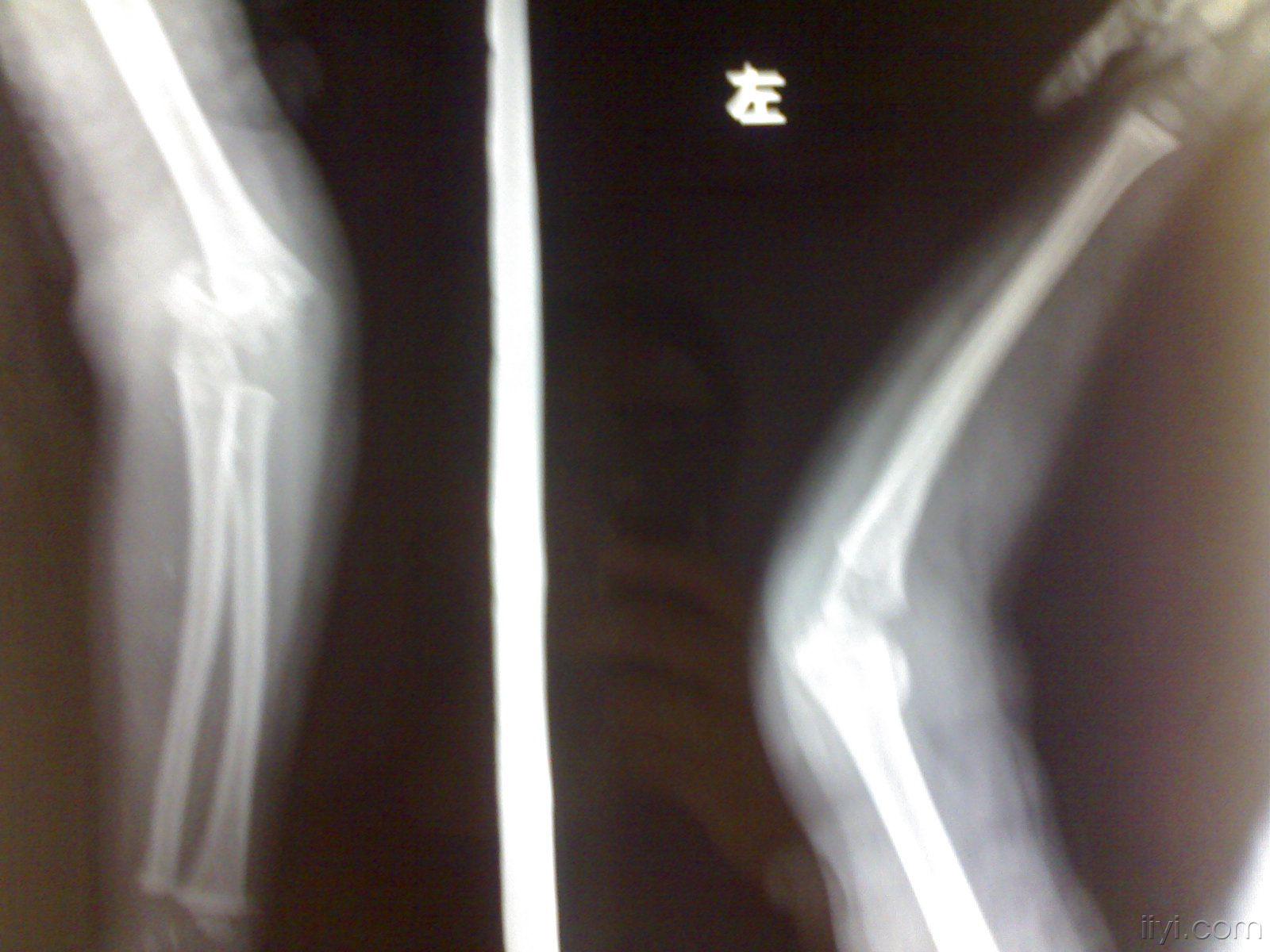 肱骨髁上楔形截骨矫正肘内翻——上海六院保肢专家文根 - 知乎