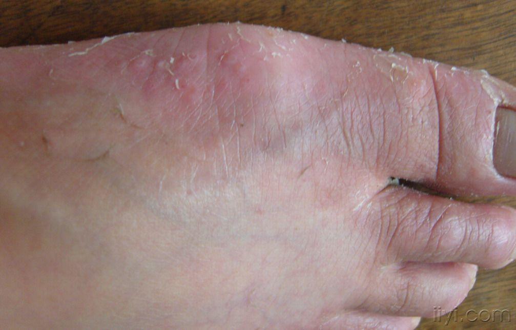 看图十年足病顽疾