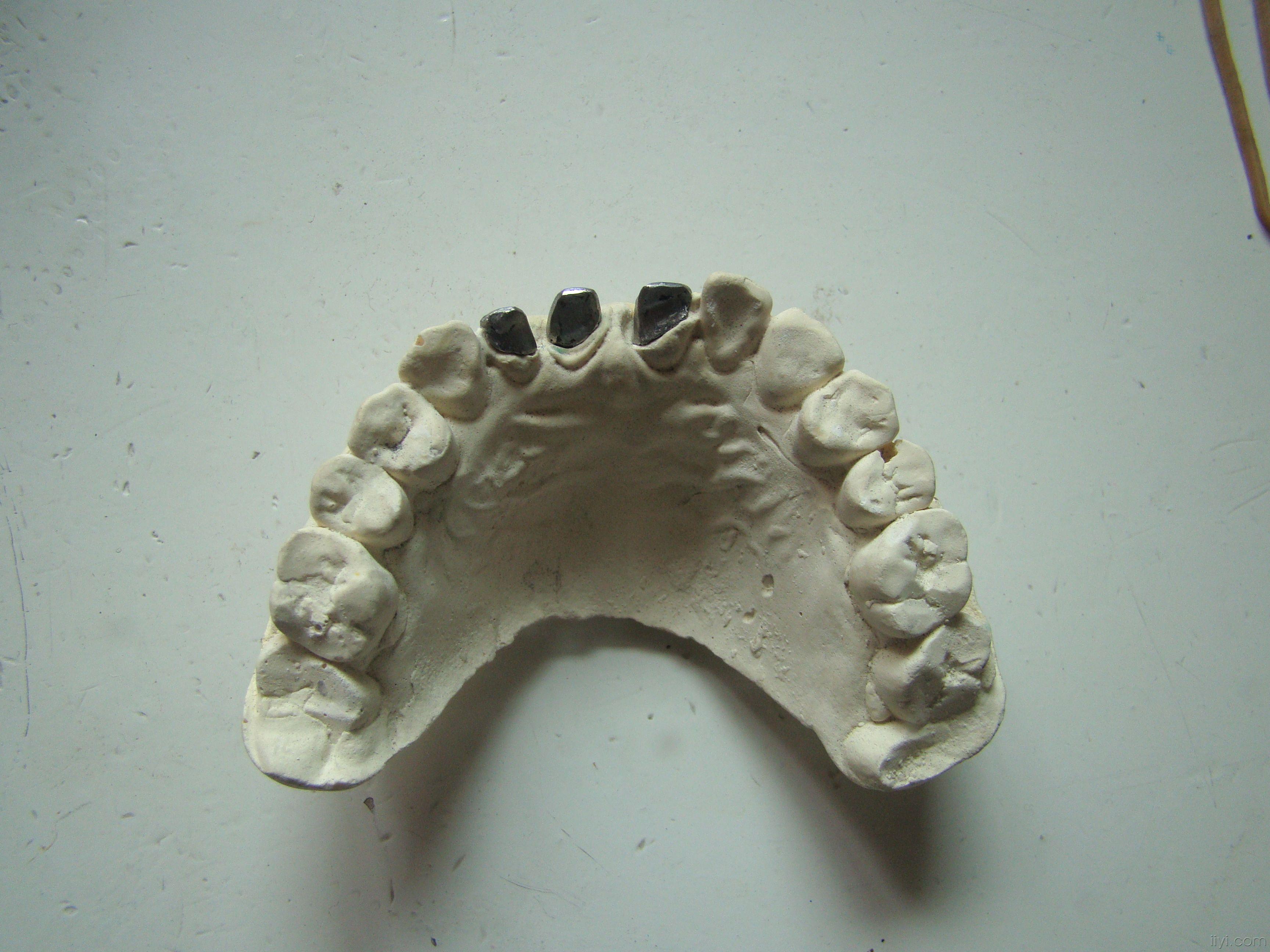 自凝树脂临时牙制作图片