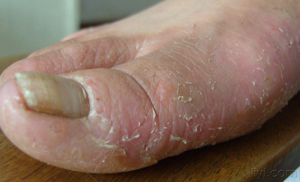 看图十年足病顽疾