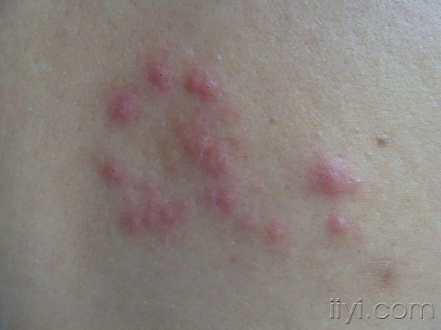 单纯疱疹病毒1型图片