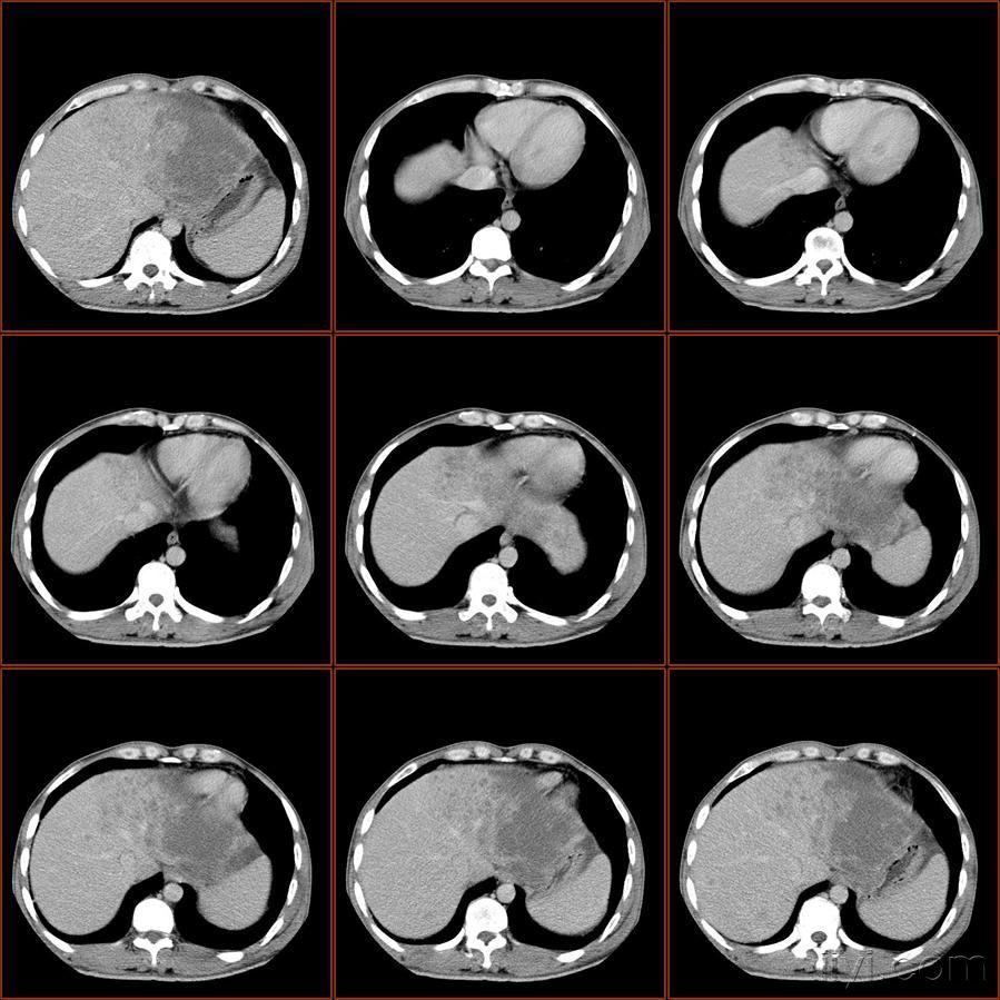 肝左叶病变有随访结果已公布随访结果