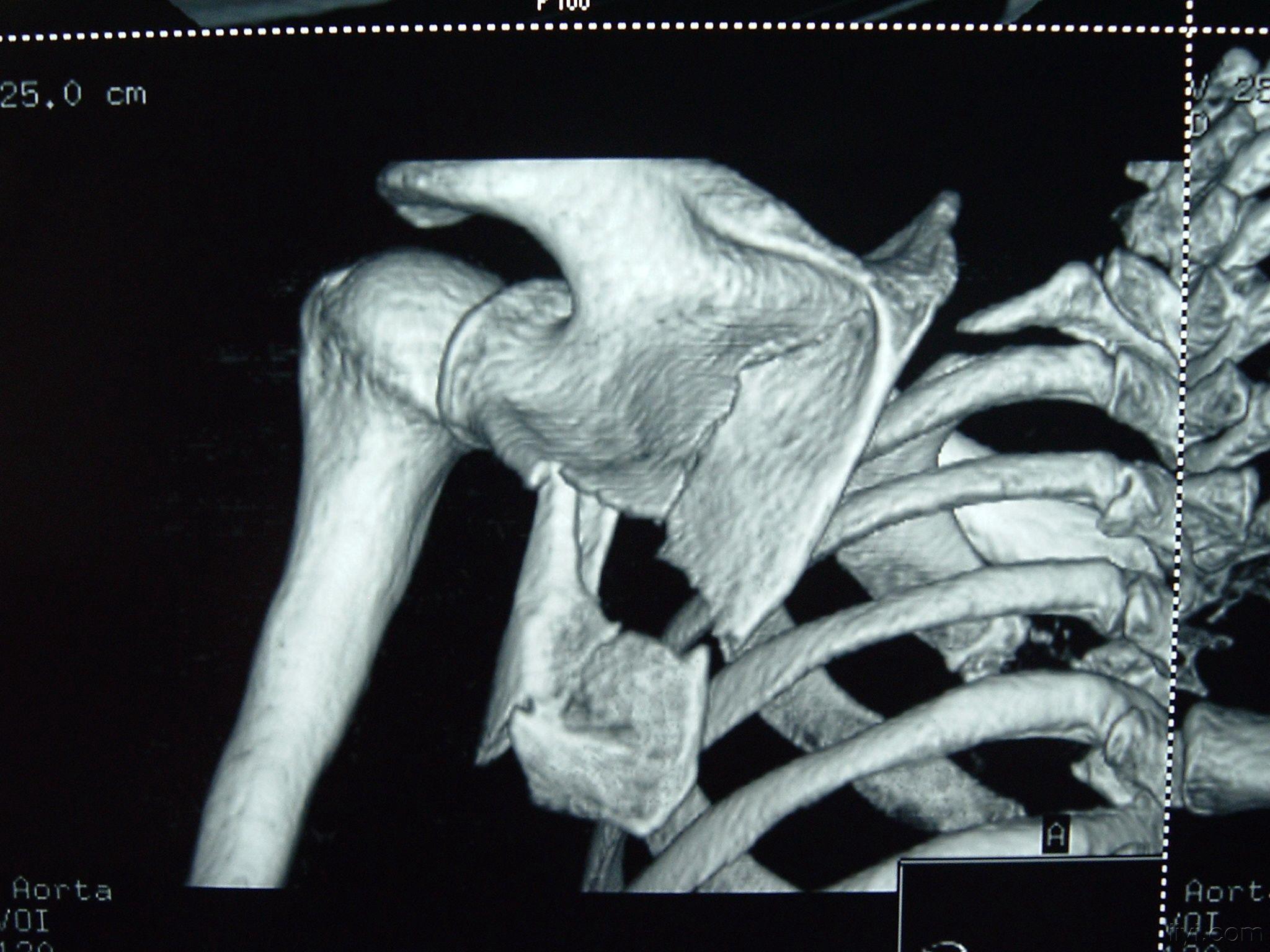 肩胛骨粉碎性骨折图片图片
