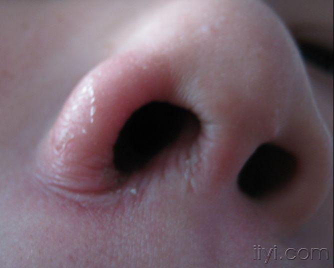 小孩鼻子螨虫图片图片