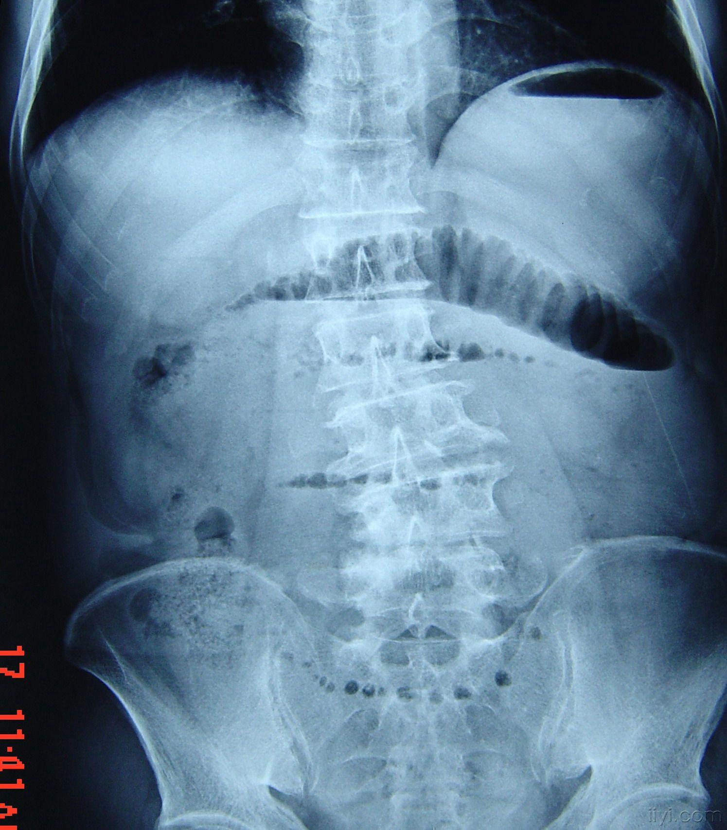 肠梗阻x线表现图片图片