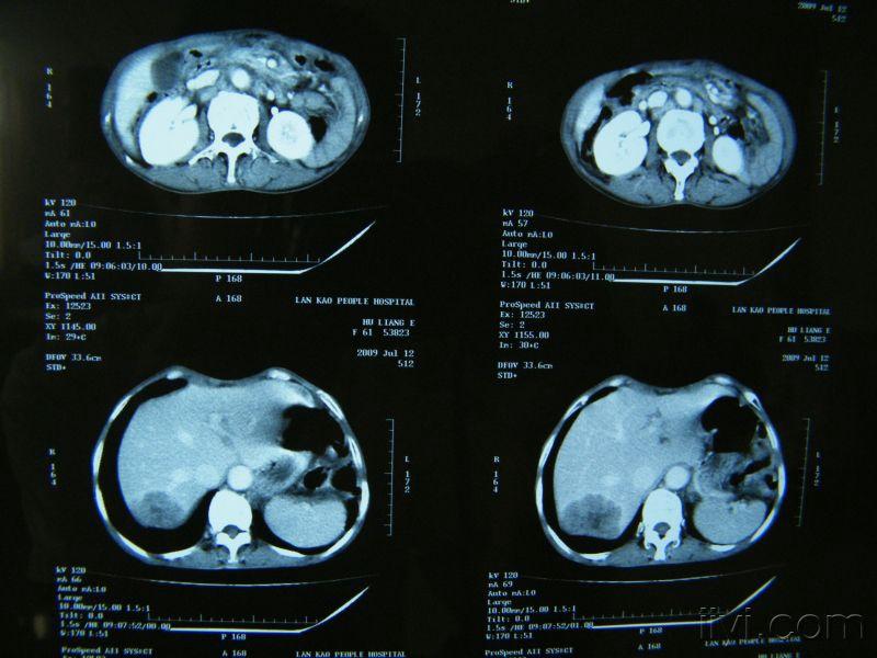 一例食管癌肝转移的ct片
