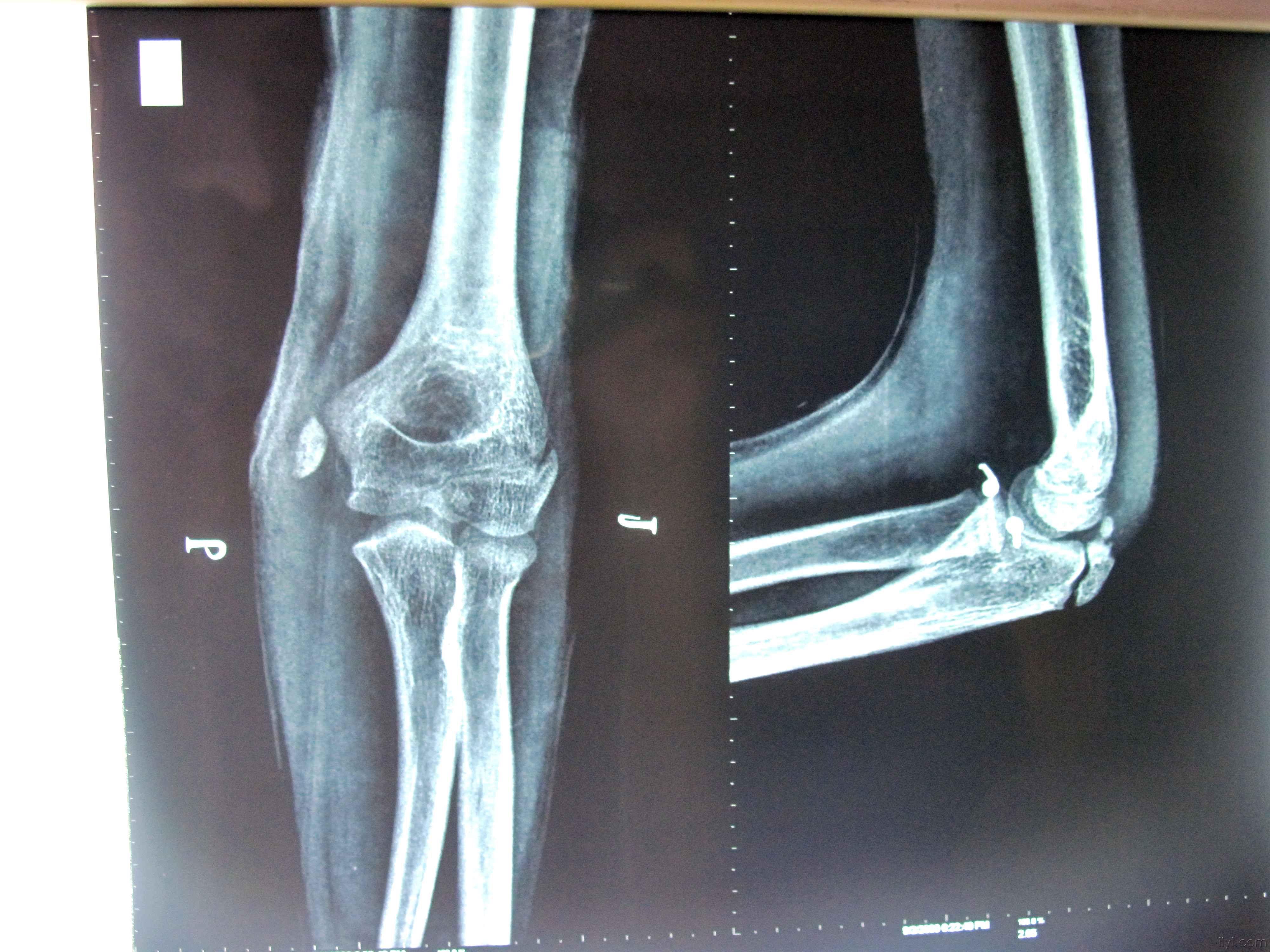 左肱骨上段骨折的图片图片