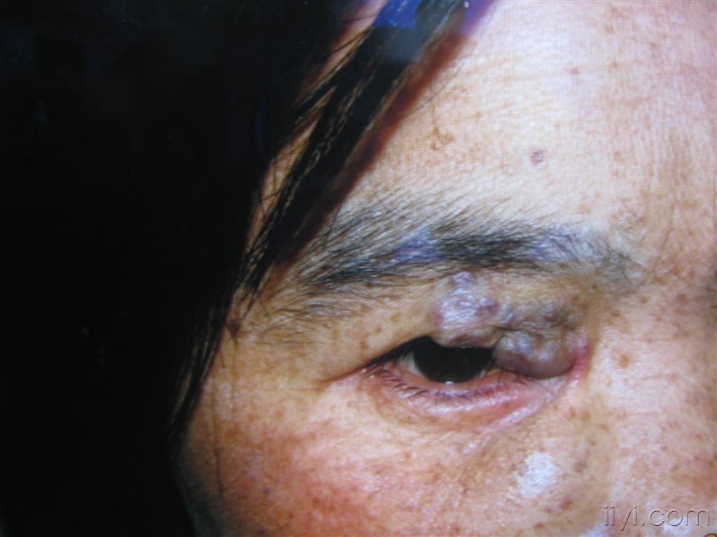 眼睑海绵状血管瘤图片图片