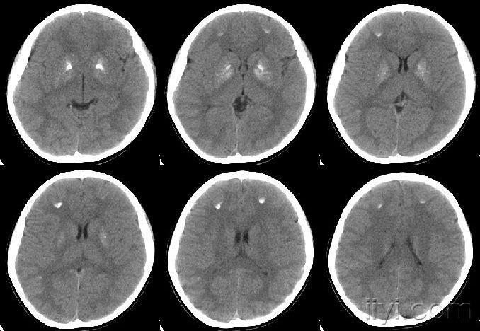 小脑齿状核钙化图片图片