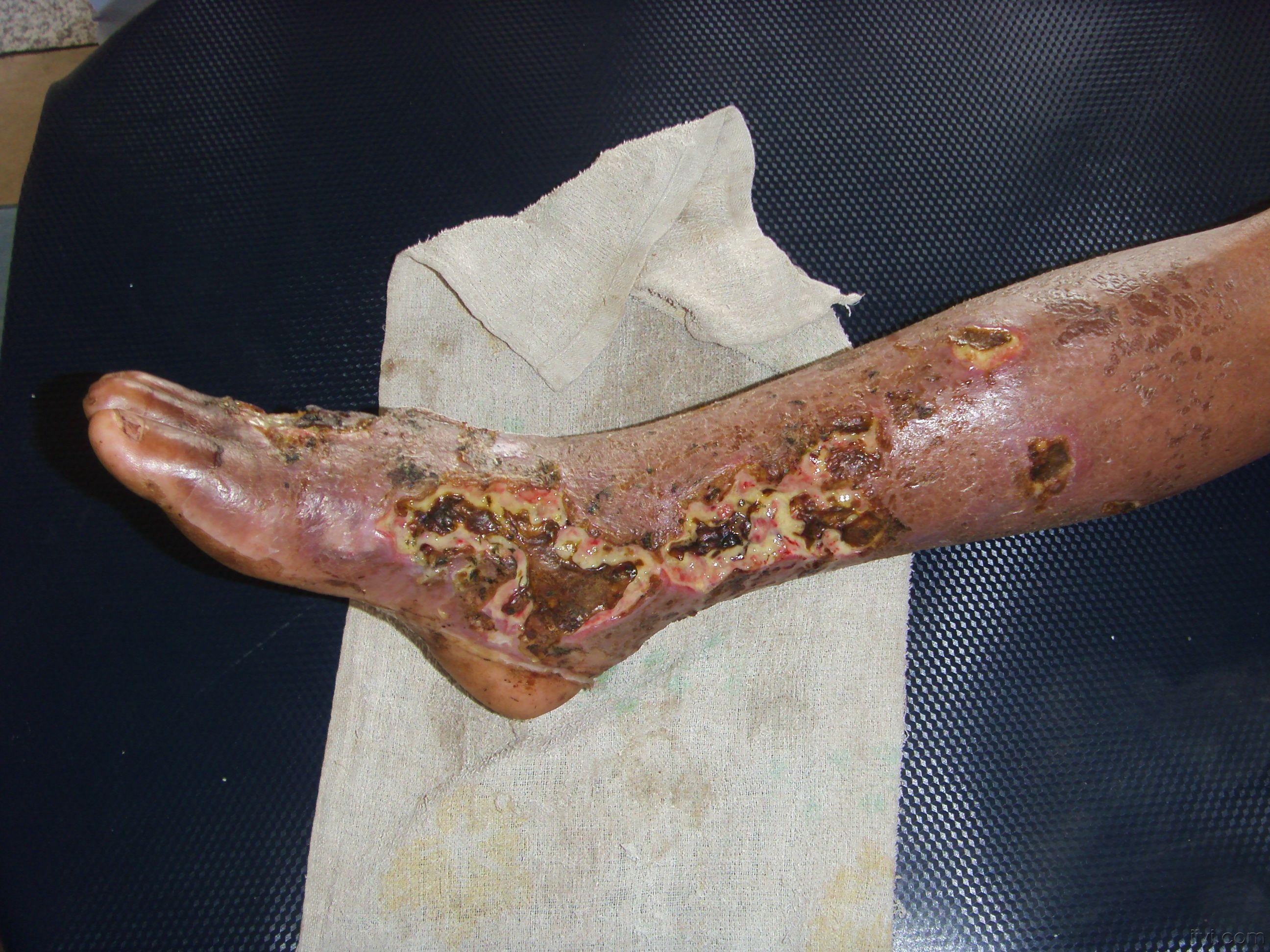 丹毒早期图片下肢图片