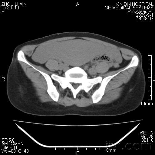 难得一见的妇女产后子宫ct! - 医学影像学讨论版 - 爱爱医医学论坛