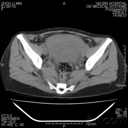 难得一见的妇女产后子宫ct! - 医学影像学讨论版 - 爱爱医医学论坛