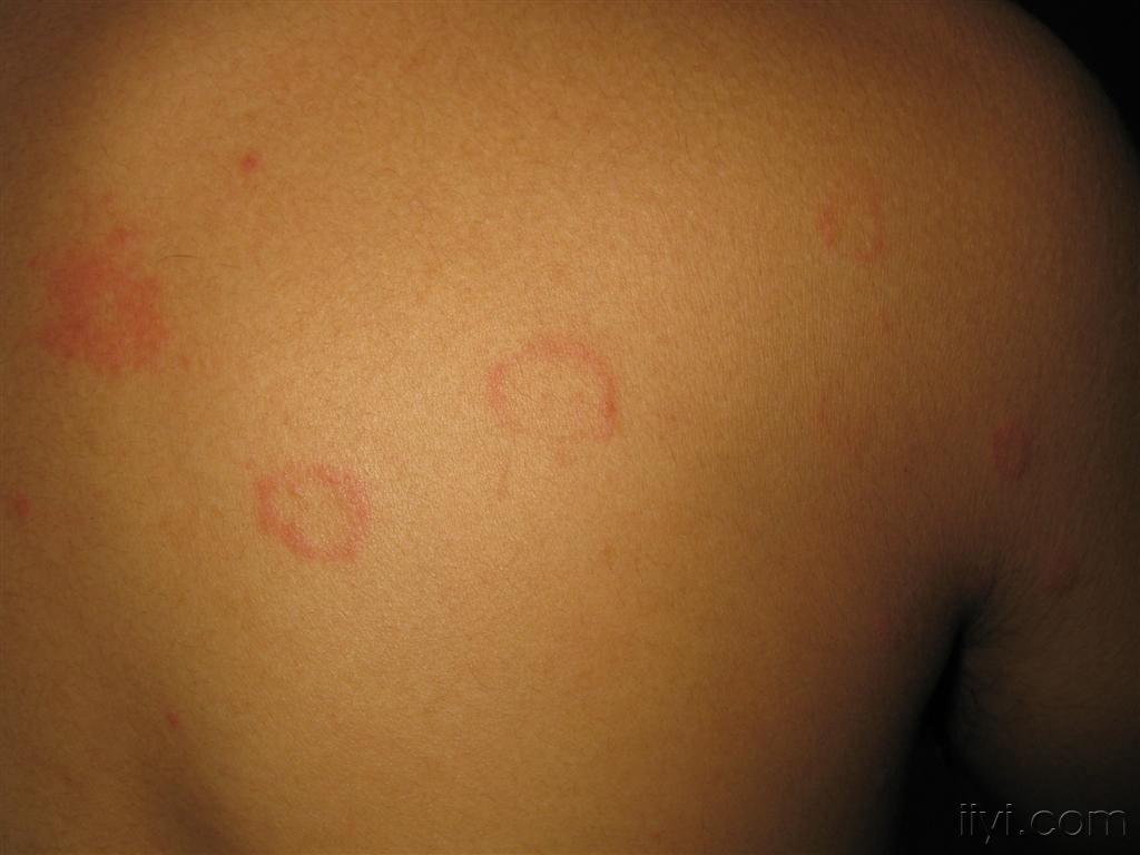 圆形红斑是什么皮肤病图片