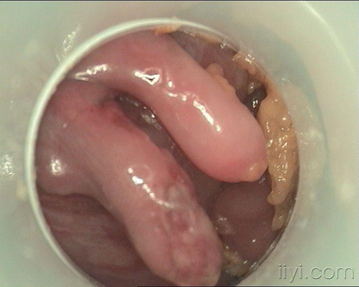 肛门长瘤子图片图片