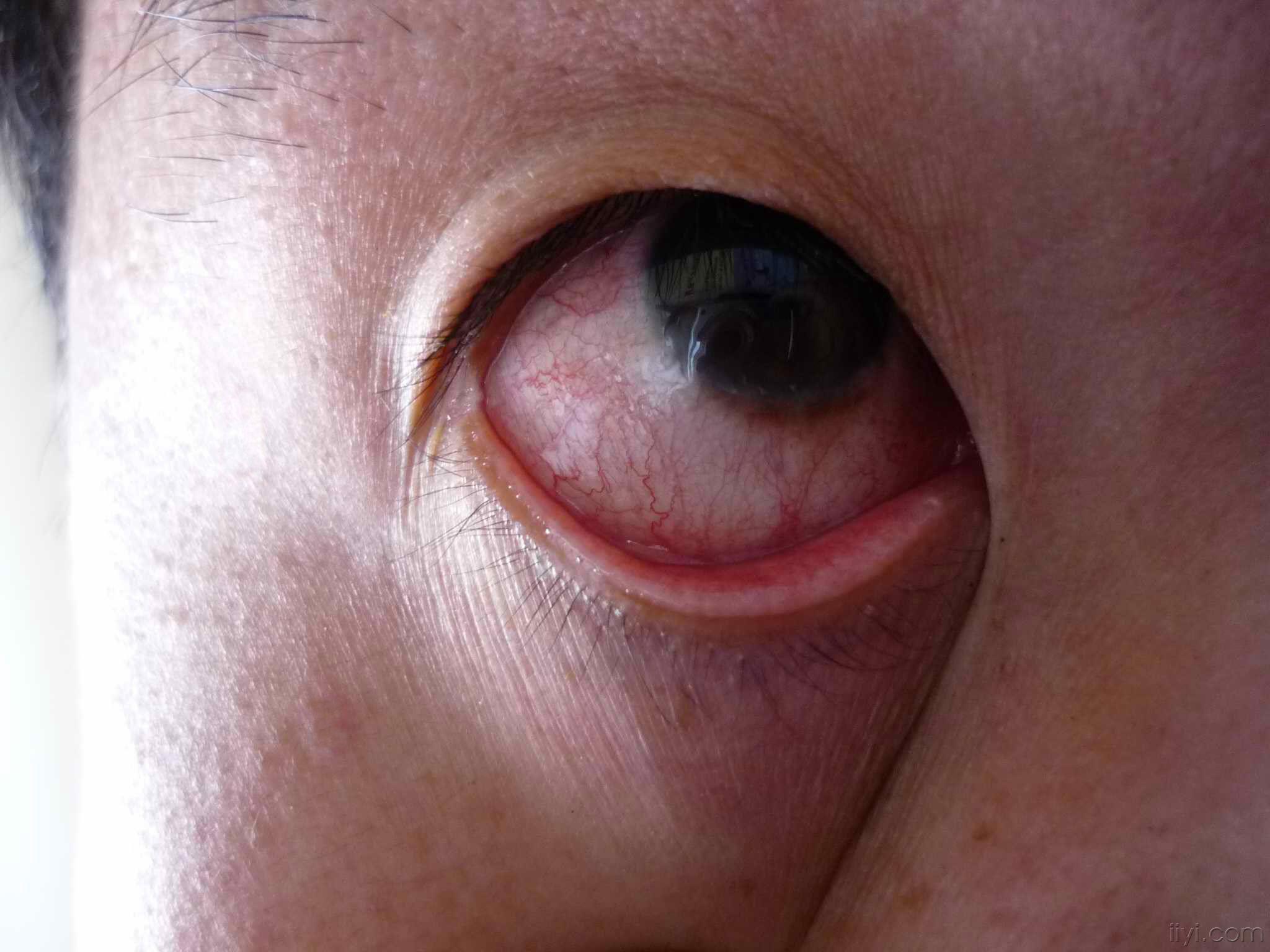 眼结膜囊肿手术前后对照 - 知乎