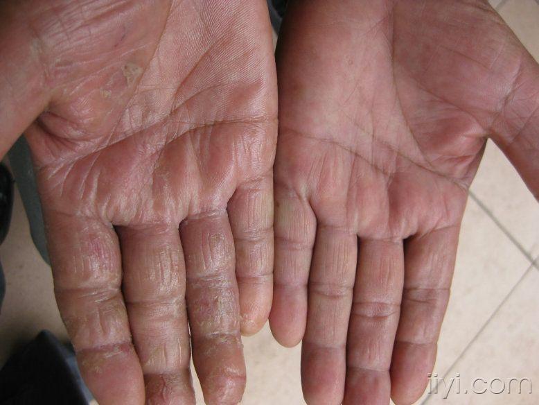 手部脱屑皲裂,耳部先天病变 - 皮肤及性传播疾病讨论版 - 爱爱医医学