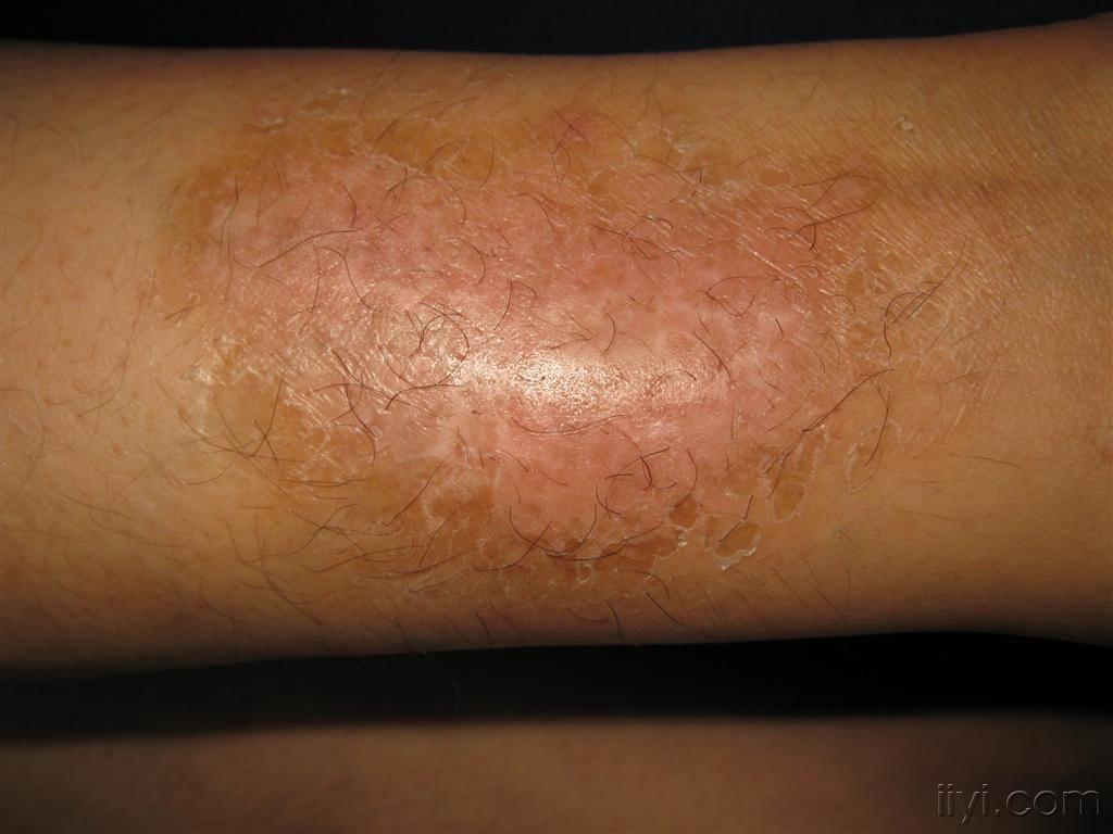 看图识病小腿慢性湿疹