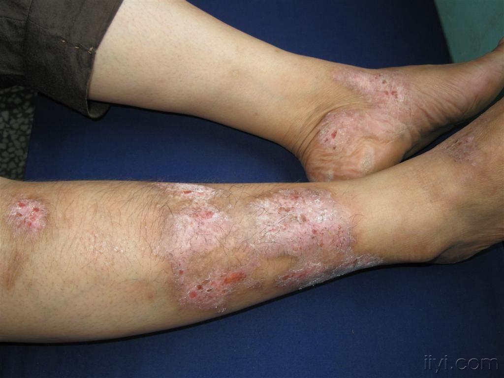 看图识病小腿慢性湿疹
