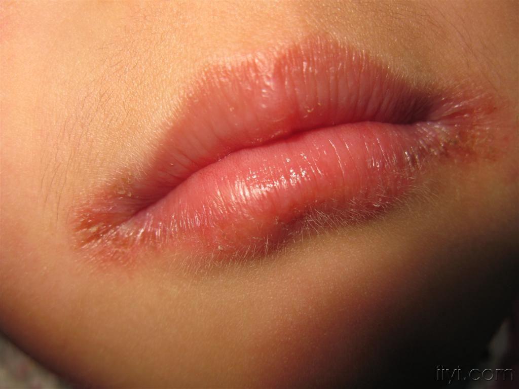 唇膏致接触性唇炎