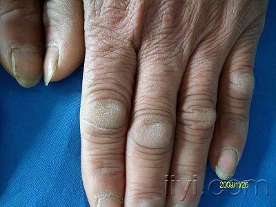 指节垫是什么症状图片图片