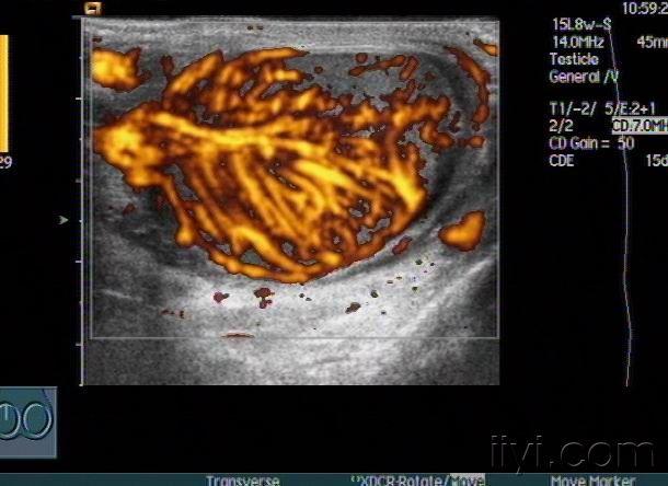 急性睾丸炎声像图zengerya