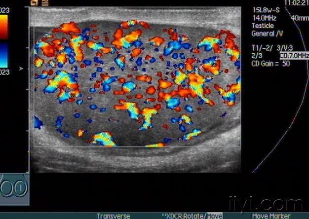 睾丸炎图片彩超图片