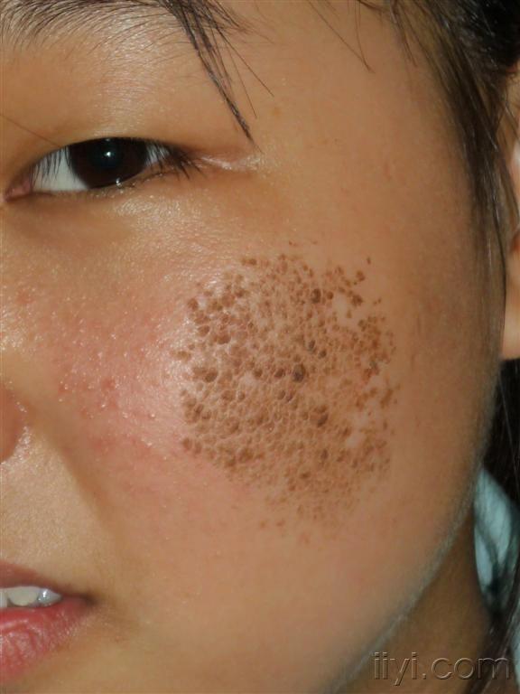 最近半年的收获皮肤垢着症