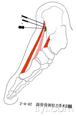 跟骨骨刺针刀动画演示图片