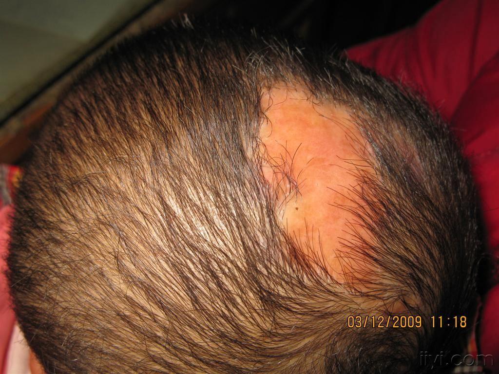 看图识病先天性头皮局部缺失