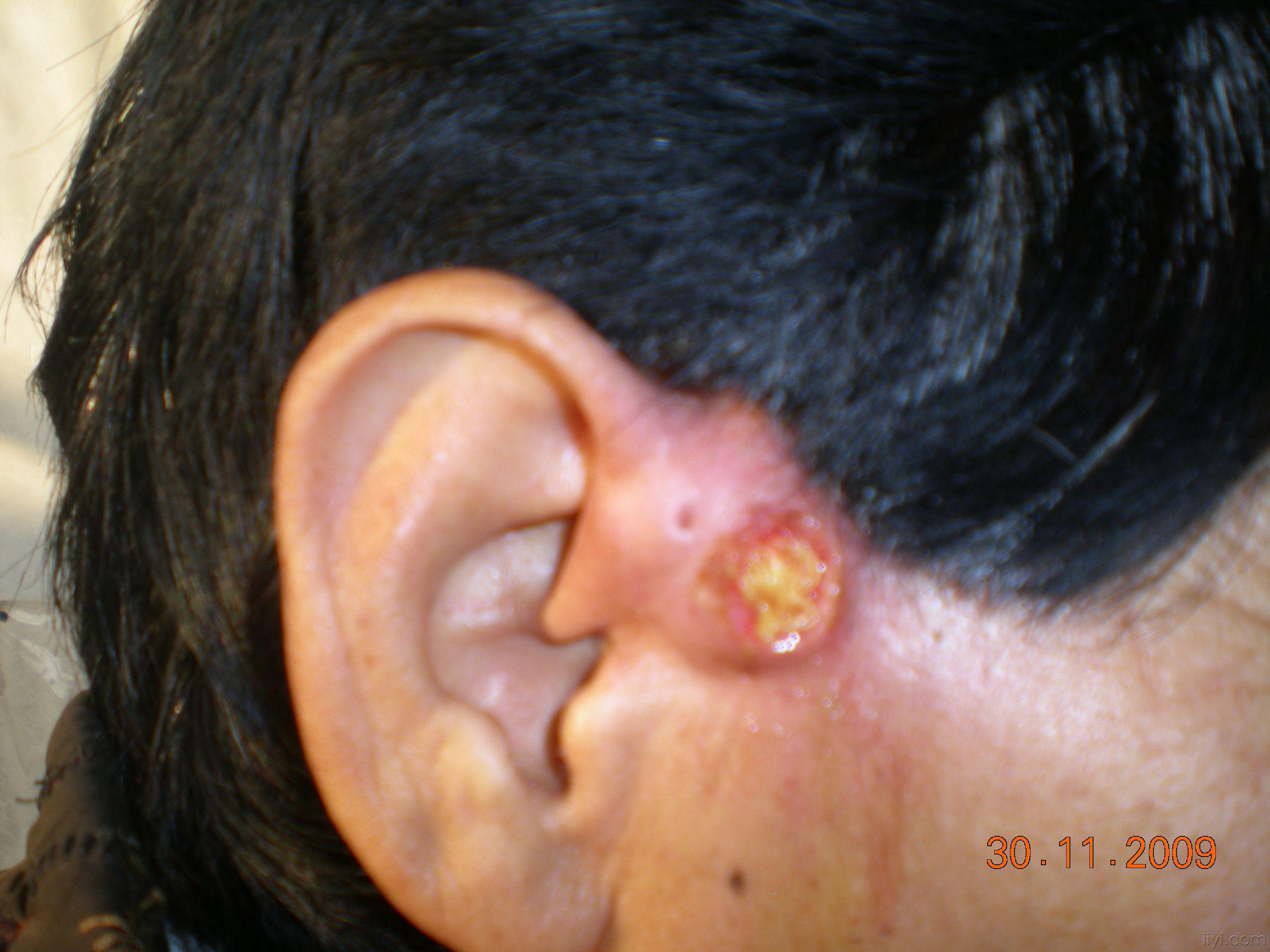 耳前瘘管发炎化脓图片