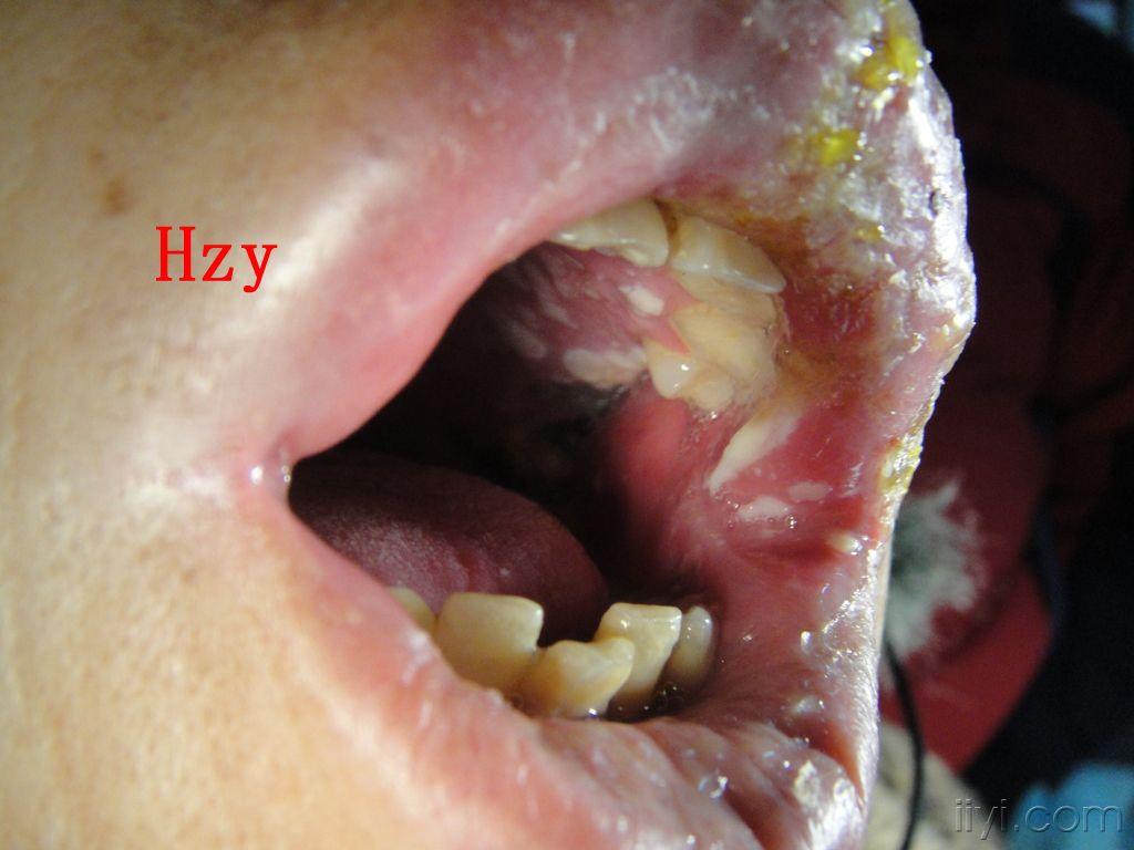 口腔内更厉害公布答案:三叉神经第二枝的带状疱疹