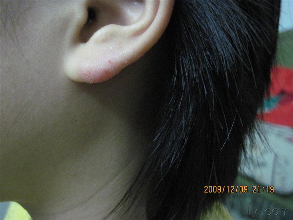 顽固皮疹寻求诊治方法