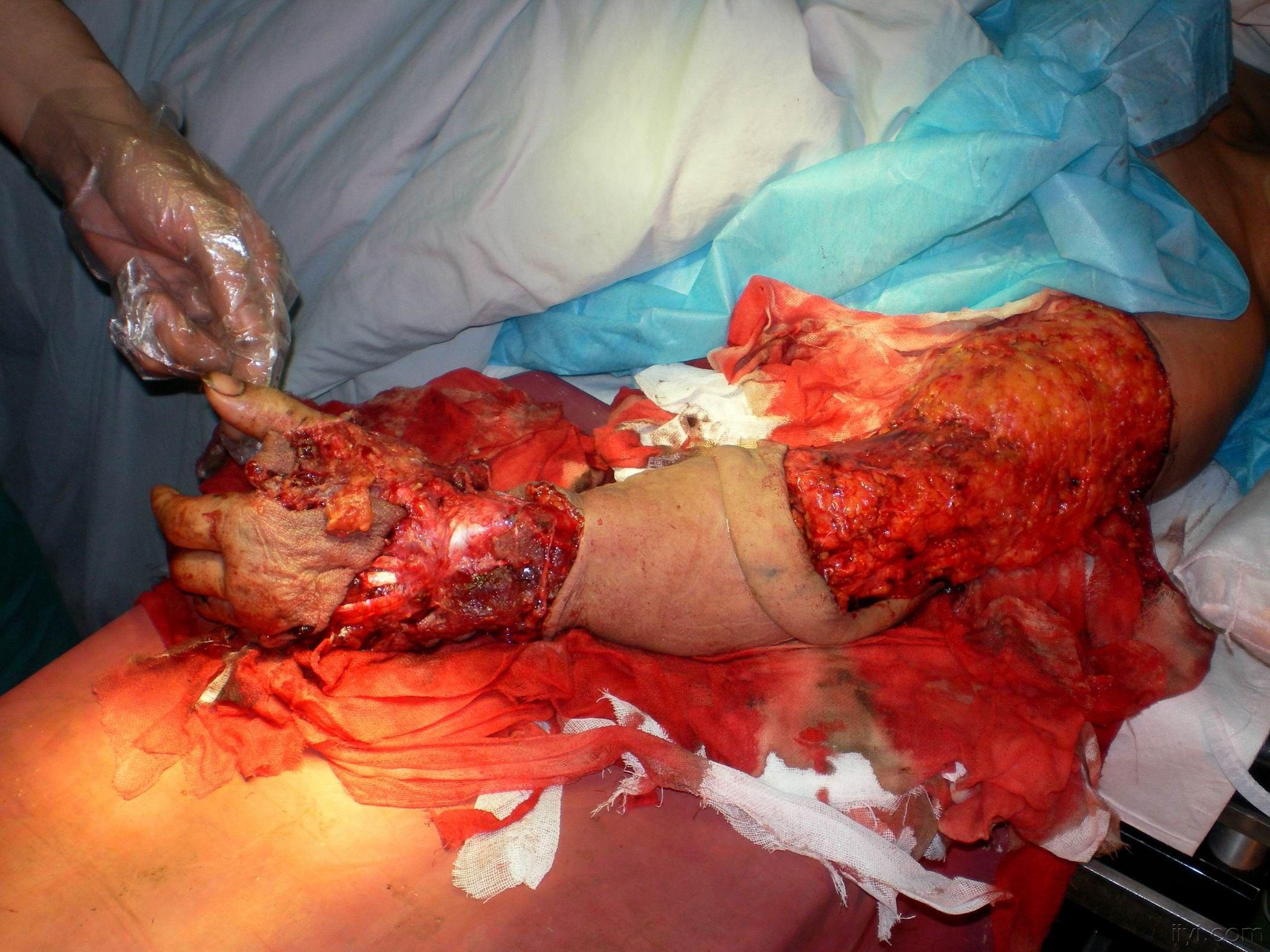 左上肢毁损伤如何治疗