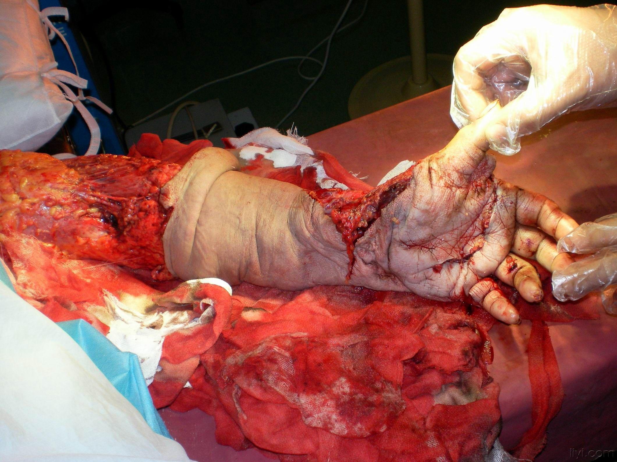 左上肢毁损伤如何治疗