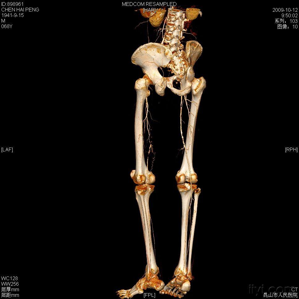 糖尿病伴左侧股动脉闭塞支架植入术后