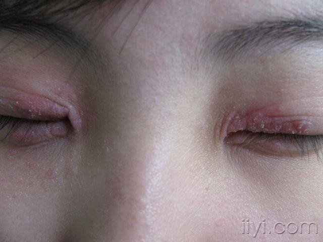 眼睑疱疹症状图片图片
